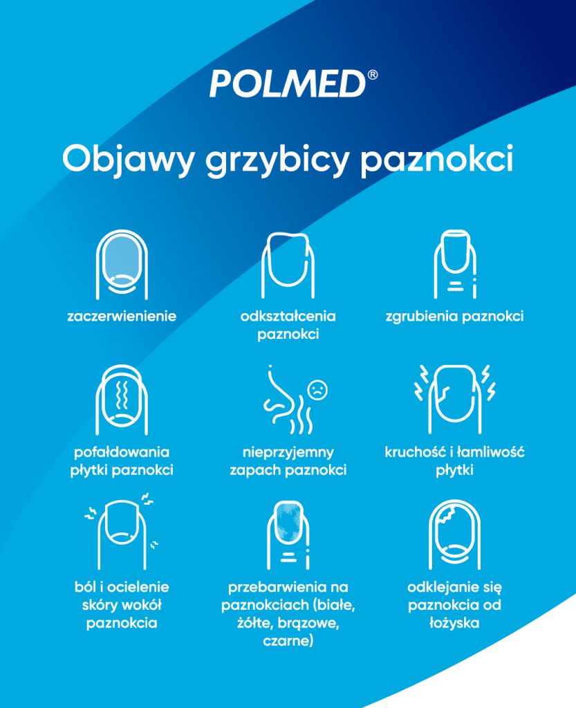Objawy grzybicy paznokci